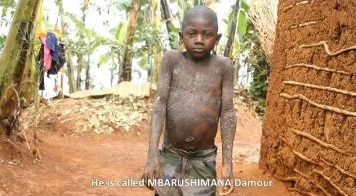 12-Year-Old Boy Turning Into A Stone