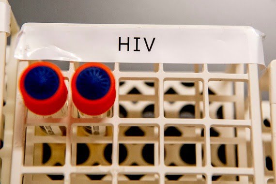 US Scientists have possibly cured HIV in a woman for the first time