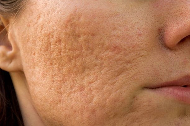7 Ways To Remove Pimples Scars On The Face, The Fast Way